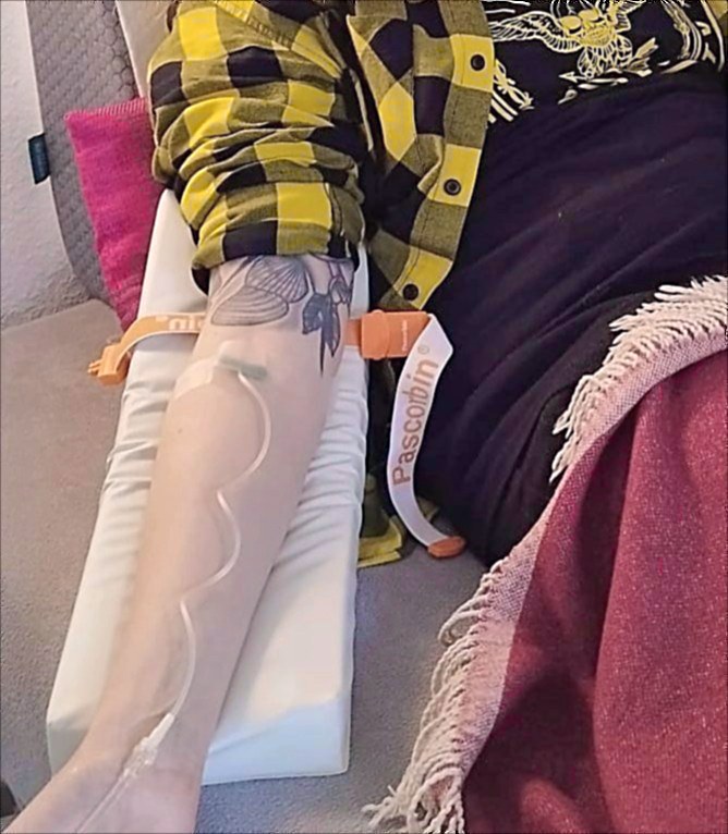 Arm mit Infusionszugang auf der Armlehne während einer Infusion in der Naturheilpraxis