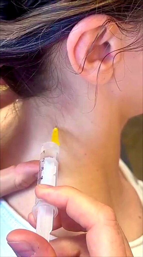 Neuraltherapie: Injektion am Nacken bei Verspannungen
